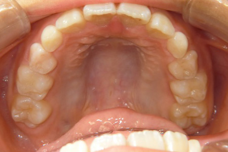 小児矯正 治療例その1　治療後　上歯