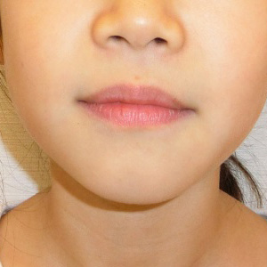 小児矯正 治療例その1　治療後　顔の正面