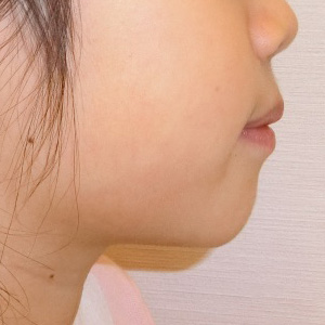 小児矯正 治療例その1　治療後　顔の横から