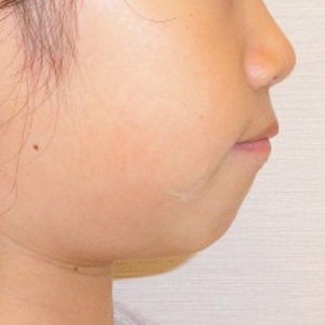 小児矯正 治療例その1　治療前　顔の横から