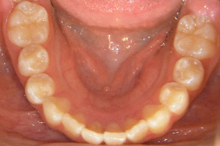 茶沢通り矯正歯科の小児矯正の筋機能矯正装置の様子 矯正後写真5