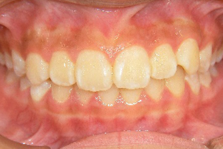茶沢通り矯正歯科の小児矯正の筋機能矯正装置の様子 矯正後写真2