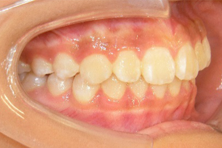 茶沢通り矯正歯科の小児矯正の筋機能矯正装置の様子 矯正後写真1