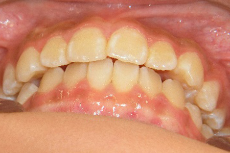 茶沢通り矯正歯科の小児矯正の筋機能矯正装置の様子 矯正後写真6