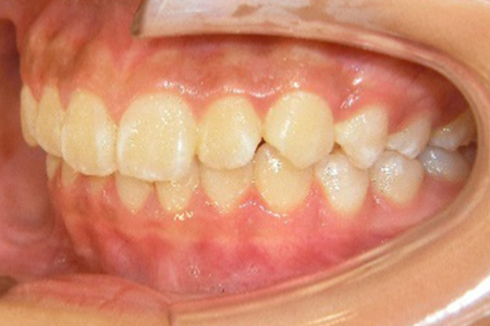茶沢通り矯正歯科の小児矯正の筋機能矯正装置の様子 矯正後写真3