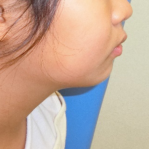 茶沢通り矯正歯科の小児矯正の筋機能矯正装置の様子 矯正後横顔写真