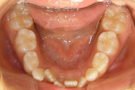 茶沢通り矯正歯科の小児矯正の筋機能矯正装置の様子 矯正前写真5