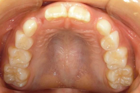 茶沢通り矯正歯科の小児矯正の筋機能矯正装置の様子 矯正前写真4