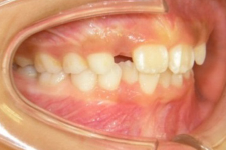茶沢通り矯正歯科の小児矯正の筋機能矯正装置の様子 矯正前写真1