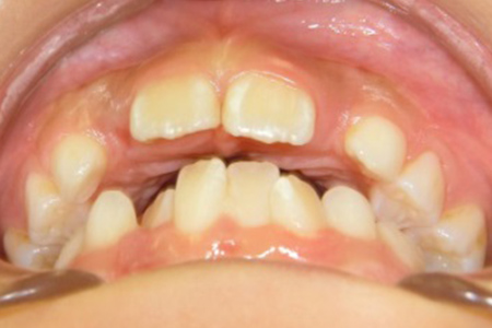 茶沢通り矯正歯科の小児矯正の筋機能矯正装置の様子 矯正前写真6