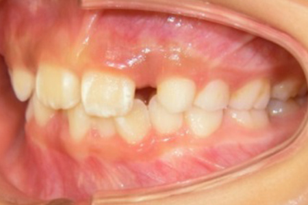 茶沢通り矯正歯科の小児矯正の筋機能矯正装置の様子 矯正前写真3