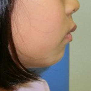 茶沢通り矯正歯科の小児矯正の筋機能矯正装置の様子 矯正前横顔写真