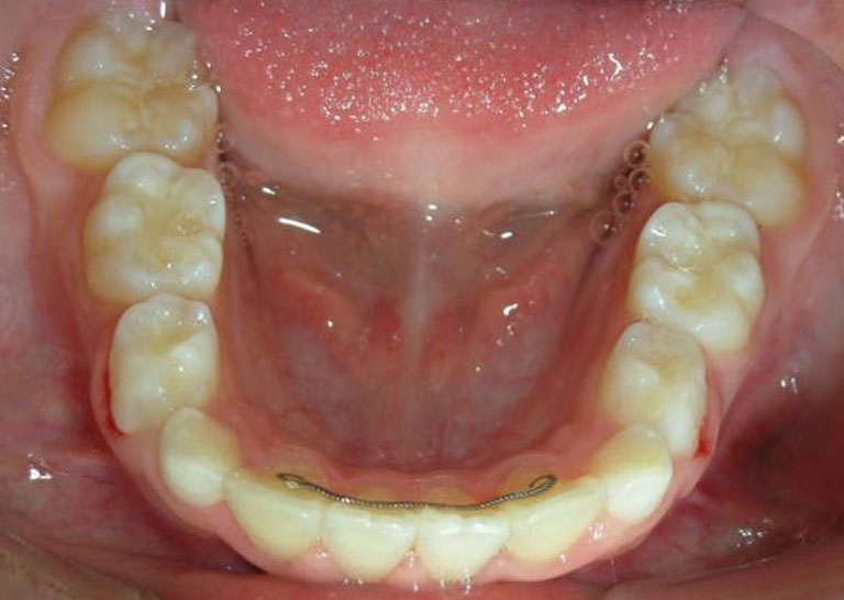茶沢矯正歯科の拡大プレート 治療例