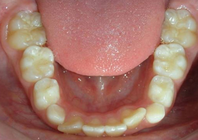 茶沢矯正歯科の拡大プレート 治療例