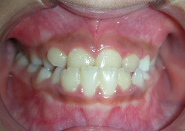 茶沢矯正歯科の早期矯正治療 筋機能矯正　上顎前方牽引装置