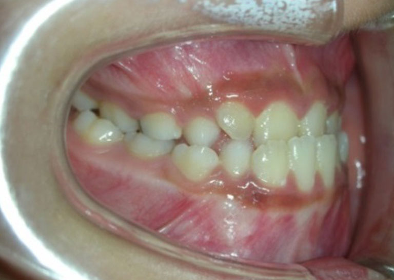 茶沢矯正歯科の早期矯正治療 筋機能矯正　上顎前方牽引装置