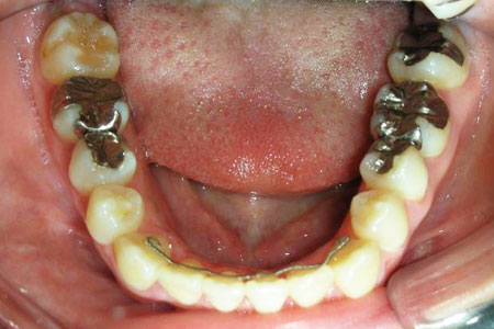 叢生治療その1　治療後下歯