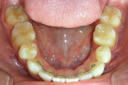 叢生治療その2　治療後下歯
