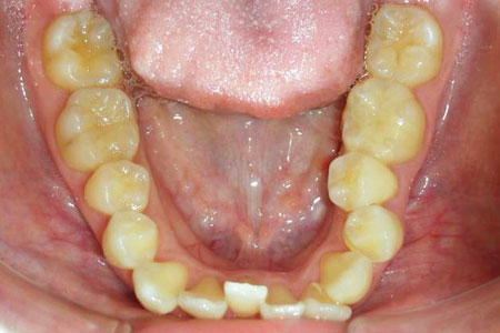叢生治療その2　治療前下歯