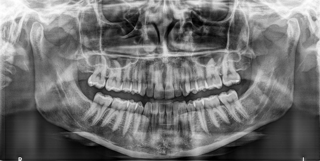 歯科用3DCTセファロ複合機　通常パノラマ