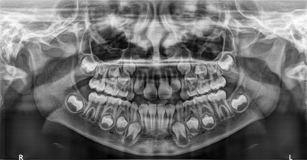 歯科用3DCTセファロ複合機　小児用撮影