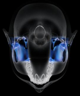 歯科用3DCTセファロ複合機　顎関節4方向撮影