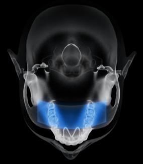 歯科用3DCTセファロ複合機　上顎洞撮影