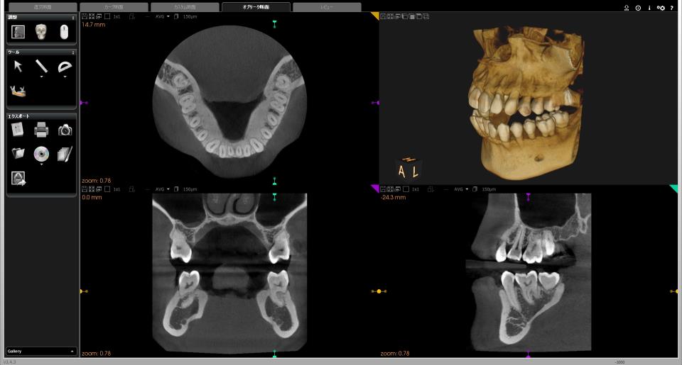 歯科用3DCTセファロ複合機　2つのCT撮影モード