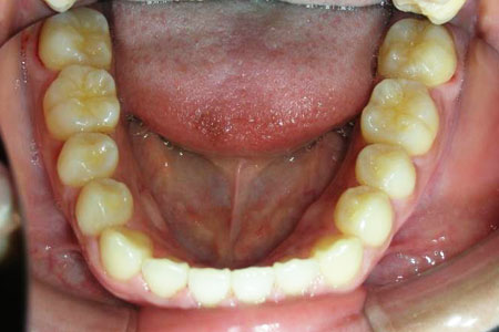 空隙歯列その1　治療後　下歯
