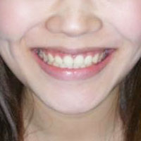 空隙歯列その1　治療後　笑顔の顔
