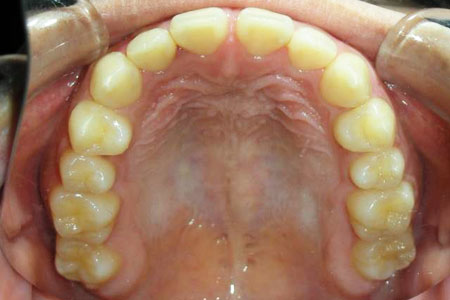 空隙歯列その1　治療前　上歯