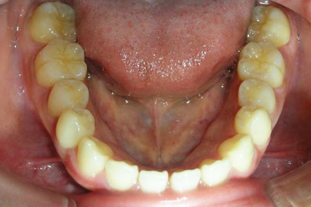 空隙歯列その1　治療前　下歯