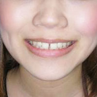 空隙歯列その1　治療前　笑顔の顔