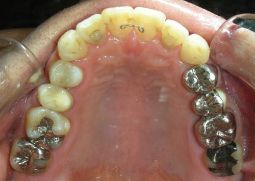 茶沢通り矯正歯科 部分矯正治療例1　口腔内アフター画像