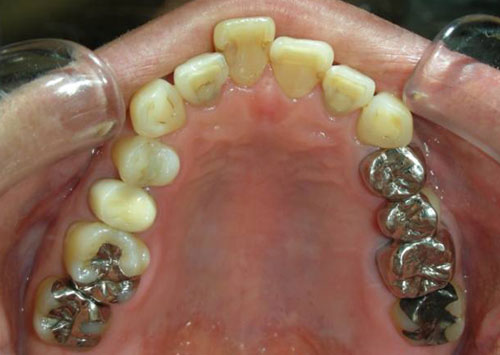茶沢通り矯正歯科 部分矯正治療例1　口腔内ビフォアー画像