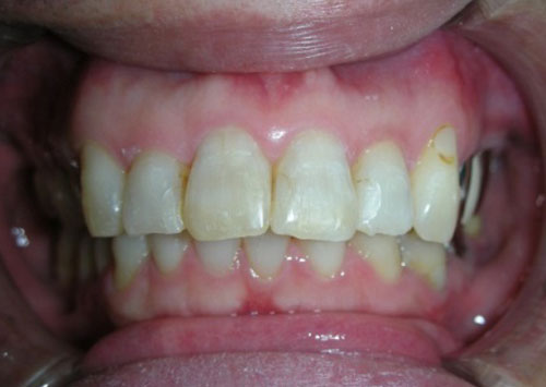 茶沢通り矯正歯科 部分矯正治療例1　前面アフター画像