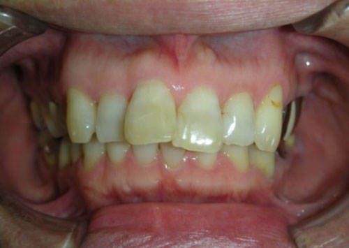 茶沢通り矯正歯科 部分矯正治療例1　前面ビフォアー画像