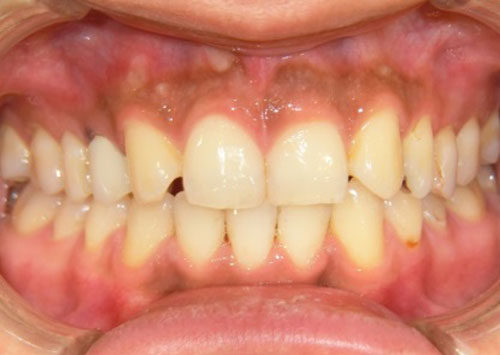 茶沢通り矯正歯科 部分矯正治療例2　前面アフター画像