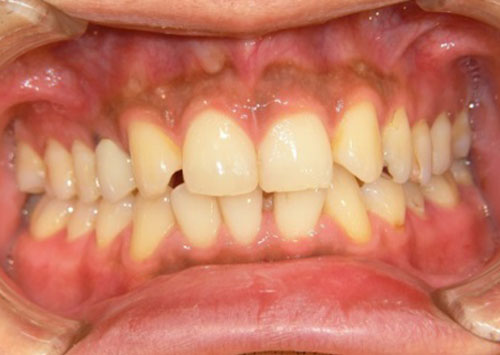 茶沢通り矯正歯科 部分矯正治療例2　前面ビフォアー画像