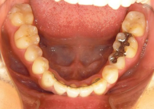 茶沢通り矯正歯科 部分矯正治療例2　口腔内アフター画像