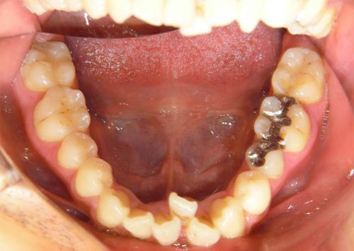 茶沢通り矯正歯科 部分矯正治療例2　口腔内ビフォアー画像