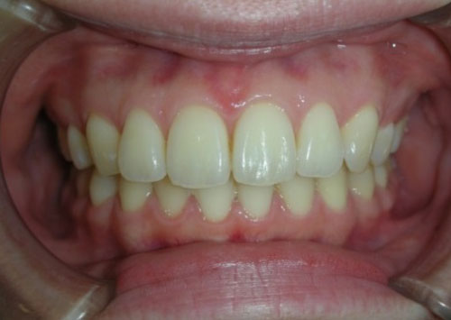 茶沢通り矯正歯科 部分矯正治療例3　前面アフター画像