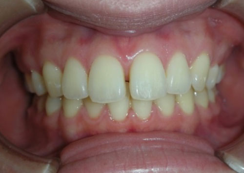 茶沢通り矯正歯科 部分矯正治療例3　前面ビフォアー画像