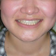 下顎前突その1　治療後笑顔の顔