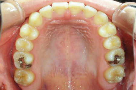 下顎前突その1　治療前上歯
