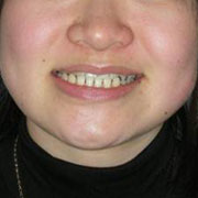 下顎前突その1　治療前笑顔の顔