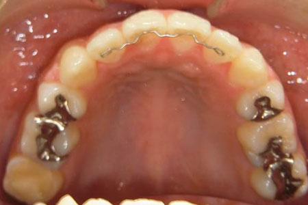 下顎前突その2　治療後上歯