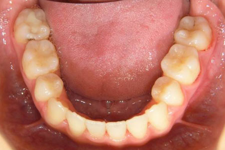 下顎前突その2　治療後下歯
