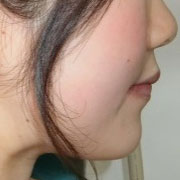 下顎前突その2　治療後顔の横から