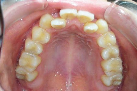 下顎前突その2　治療前上歯